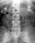 Urinary Tract Stones Initial Xray