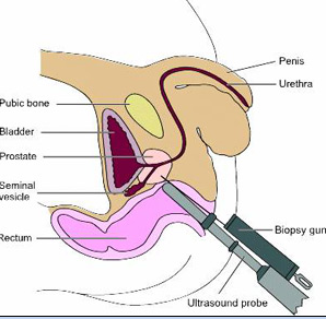 Prostate Diseases Ultrasound probe