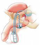 Post prostatectomy Incontinence surgery