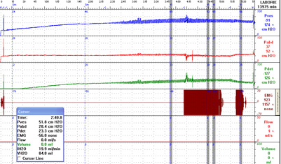 Neurogenic bladder graph