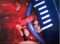 Varicocelectomy