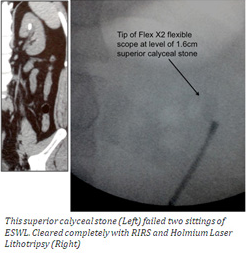 Retrograde Intrarenal Surgery, Best Andrologist & Urologist in Hyderabad